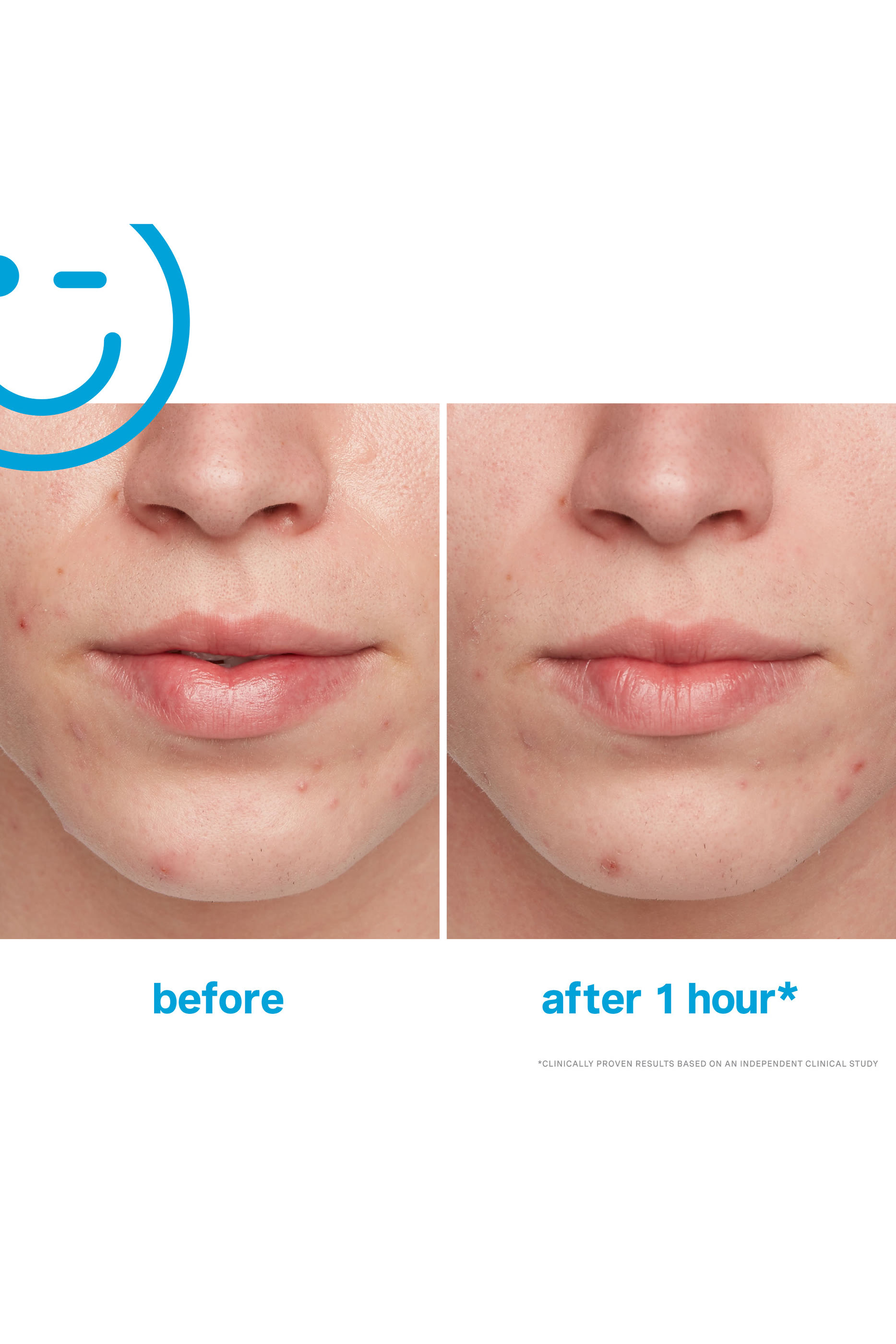 مستحضر علاجي اراديكايت للحبوب 10% كبريت